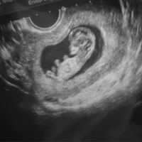 妊娠11週のエコー写真です この時期では性別は分からないと言わ Yahoo 知恵袋