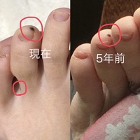 左足の薬指にほくろがあります 5年前くらいにいつの間にか増えてたので Yahoo 知恵袋