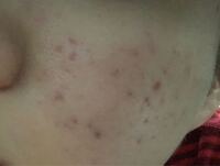 ニキビ跡が治りません 朝夜と化粧水 美容液 乳液をつけています 朝は加え Yahoo 知恵袋