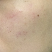 シャワーでお湯を浴びるとその直後 こういう赤いかゆみのある発疹 みた Yahoo 知恵袋