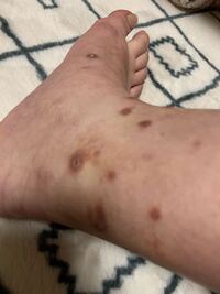 写真のような赤い斑点が足首と手指甲にでてます かゆくてお湯など Yahoo 知恵袋