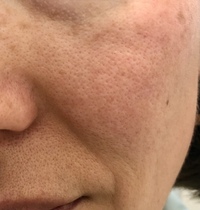 肌が汚くて悩んでいます 洗顔も毎日丁寧にして保湿もしていますが 毛穴 Yahoo 知恵袋