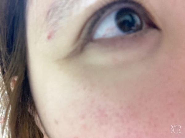 こういう目の充血がずっと治らないのですが手術で無くすことは出来ますか Yahoo 知恵袋