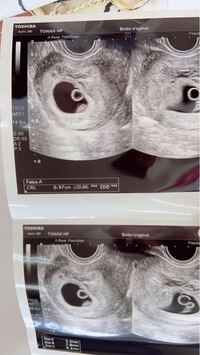 エコー写真あり 6週目の際 一卵性の双子と診断されました 本日 Yahoo 知恵袋