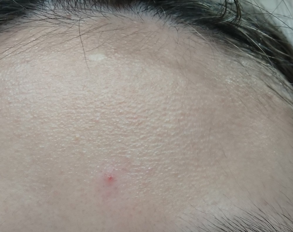 18歳女子です 写真は私のおでこの状況です 毛穴なのかわかりま Yahoo 知恵袋