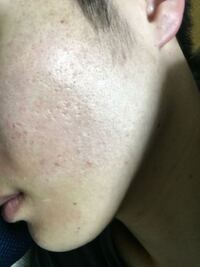 肌の汚い男性は恋愛対象外ですか Yahoo 知恵袋