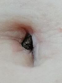 ヘソの緒の取り残し おへその中に黒い塊があり 汚れ と思い乳液と綿 Yahoo 知恵袋
