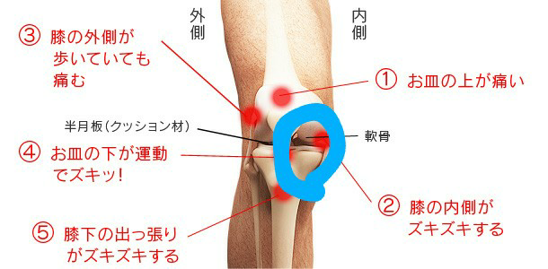 ベスト 膝 打撲 腫れ 曲げると痛い 膝 打撲 腫れ 曲げると痛い Gambarsae8o7
