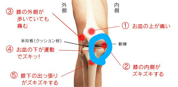 昨日 膝を打ったのですが打撲かヒビが入っているのか分かりません Yahoo 知恵袋