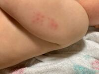 g摂取後２日目です 赤いのですがコッホ現象ですか Yahoo 知恵袋