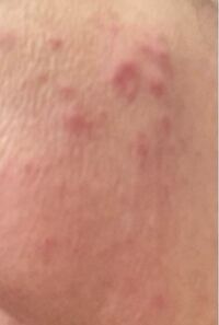 起きたら 突然 顔にボツボツ 湿疹 が出ました 原因が思い当た Yahoo 知恵袋