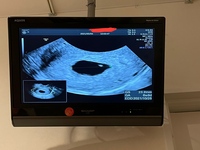 胎嚢 確認 後 流産 胎嚢確認ができない原因は 腹痛などの症状に要注意 産婦人科医監修 Milly ミリー Ofertadalu Com Br