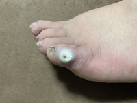 閲覧注意魚の目市販の薬を使い 魚の目の芯は取れたと思うのですが このよう Yahoo 知恵袋