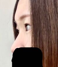 鼻根がペタンコすぎてコンプレックスなのですが これって整形するとした Yahoo 知恵袋