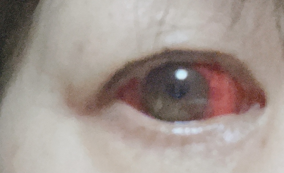 結膜下出血になりました 病院でプロラノン点眼液をもらいました 白目が全て Yahoo 知恵袋