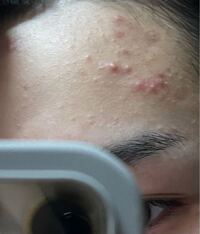 エーカー 調整する 命令的 額 女子高校生 にきび 委員長 保証する 処理する