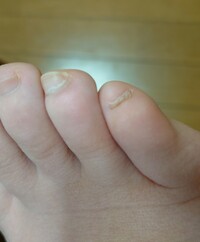 足の小指の爪がとても小さい ほぼない のですが これはもう治しようがないのでし Yahoo 知恵袋