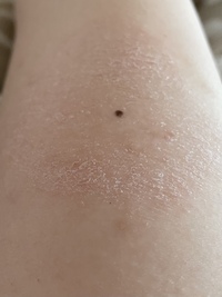 画像のように腕が皮がむけているのですが ただの乾燥なのでしょうか Yahoo 知恵袋