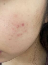 ニキビ跡が薬を塗っても消えません いい方法ありますか Yahoo 知恵袋