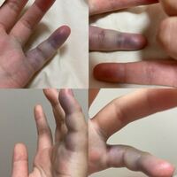 今日 体育の授業でボールが当たって突き指をしたんですがよく突き指をす Yahoo 知恵袋