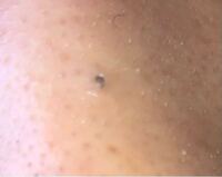 閲覧注意です 高3女子なんですけど 黒ニキビなのか毛穴なのかわからないんで Yahoo 知恵袋