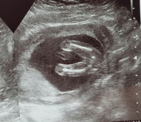 18週のエコーです 女の子 男の子どちらの確率が高いでしょうか Yahoo 知恵袋