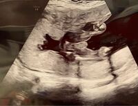 19w 5ヶ月 の妊婦です このエコー写真 男の子or女の子どちらに見えますか Yahoo 知恵袋