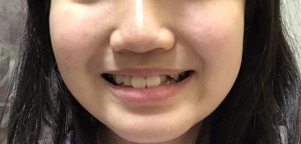 12歳女子です 私は 笑った時に頬の肉が持ち上がってできるくぼみみた Yahoo 知恵袋