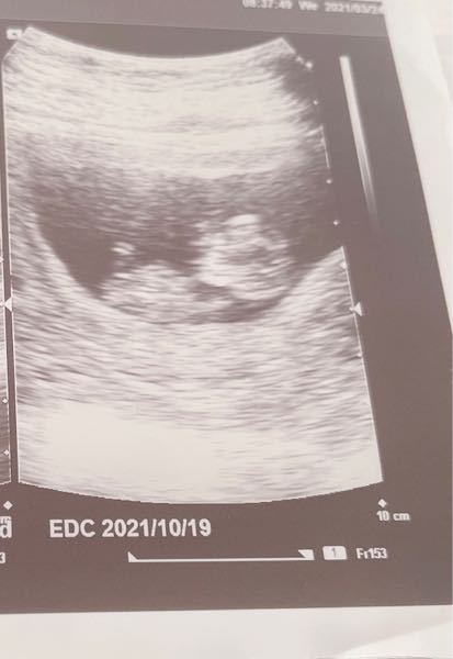 前置胎盤 ダウン症 関係