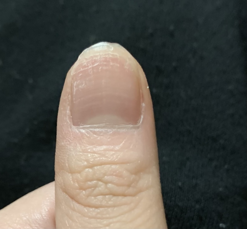これは爪水虫ですか 少し前から親指の爪に変な模様 みたいのが出てくる Yahoo 知恵袋