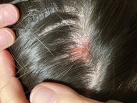 画像あり頭皮が赤くなって痒みがあり フケ 皮がポロポロ落ちるのです Yahoo 知恵袋