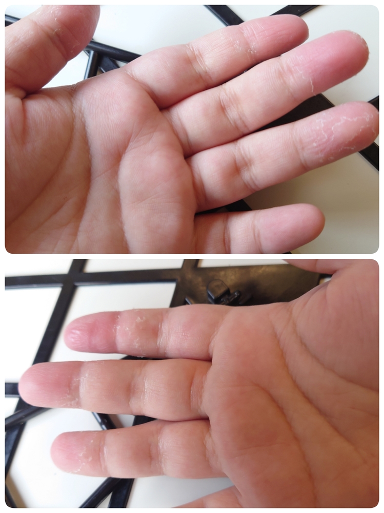 水虫 すべての質問 Yahoo 知恵袋