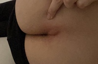 閲覧注意 臀部の写真有 一昨日からお尻の割れ目が痛くなり 昨 Yahoo 知恵袋