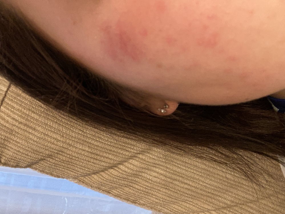 花粉症 アレルギー すべての質問 Yahoo 知恵袋