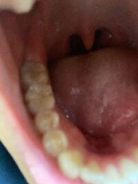 奥歯は虫歯ですよね 神経までいってそうで怖い Yahoo 知恵袋