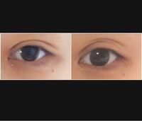 二重切開1ヶ月目です これは両方右目なのですが くい込みが浅く 右の Yahoo 知恵袋