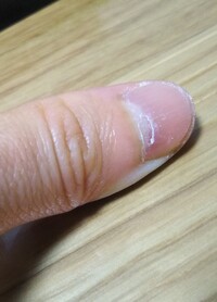 ボコボコ 原因 爪