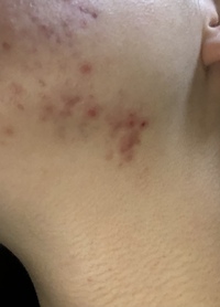 肌の画像あり Q ニキビなのかニキビ似た別の出来物か汚い肌の写真失礼します Yahoo 知恵袋