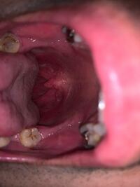 喉の痛みについて 汚い画像すいません 1か月近く喉が痛かったり痛くなかっ Yahoo 知恵袋