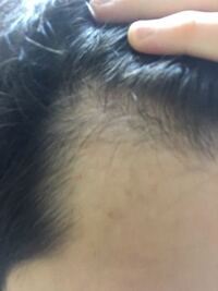 これは発毛剤 育毛剤どっちですか まず前提として頭皮状態からa Yahoo 知恵袋