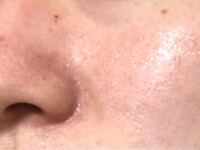 鼻の周りから頬が1年前から痒い湿疹です 皮膚科へ3回ほど行って Yahoo 知恵袋