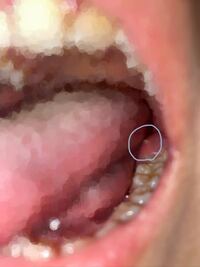 お見苦しい写真失礼します 新しく歯が生え始め歯茎が腫れていたのですが 数日前か Yahoo 知恵袋