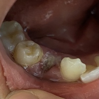 お見苦しい写真すみません 歯列矯正のために16日に第一小臼歯を抜歯し Yahoo 知恵袋