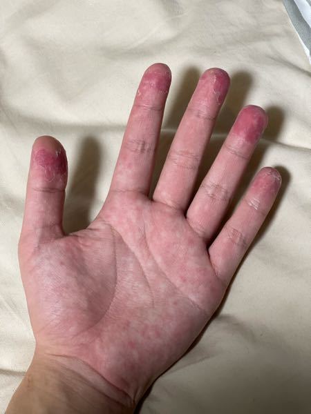 皮膚の病気 アトピー 解決済みの質問 Yahoo 知恵袋