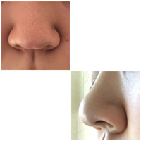 毛穴等汚くてすみません 鼻がコンプレックスで人前では顔も見せたくない Yahoo 知恵袋