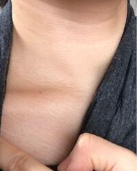 首から鎖骨の所の画像なんですけど 毛穴 毛 が詰まってザラザラして目に見 Yahoo 知恵袋