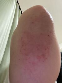 閲覧注意 肘が写真のように荒れてしまったのですがどうしたら治ります Yahoo 知恵袋