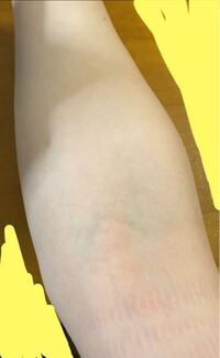 この腕は採血取るのにあまり手こずらないと思いますか 血管見えて Yahoo 知恵袋