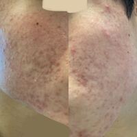 ニキビ跡について 現在 皮膚科からいただいた薬で治療中なのですが まだま Yahoo 知恵袋