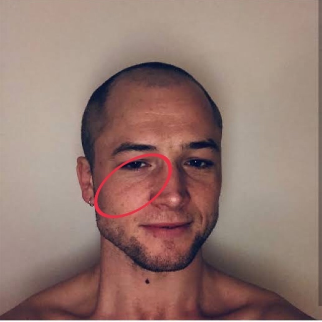 英米人に多い目の下のこの線は彫りが深い人あるあるなんですか？